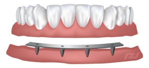 Implant Supported Dentures in Cornelius, NC