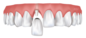 CEREC Same-Day Dental Crowns in Cornelius, NC