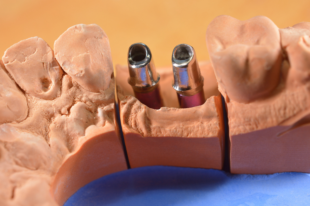 Dental Implants Explained 