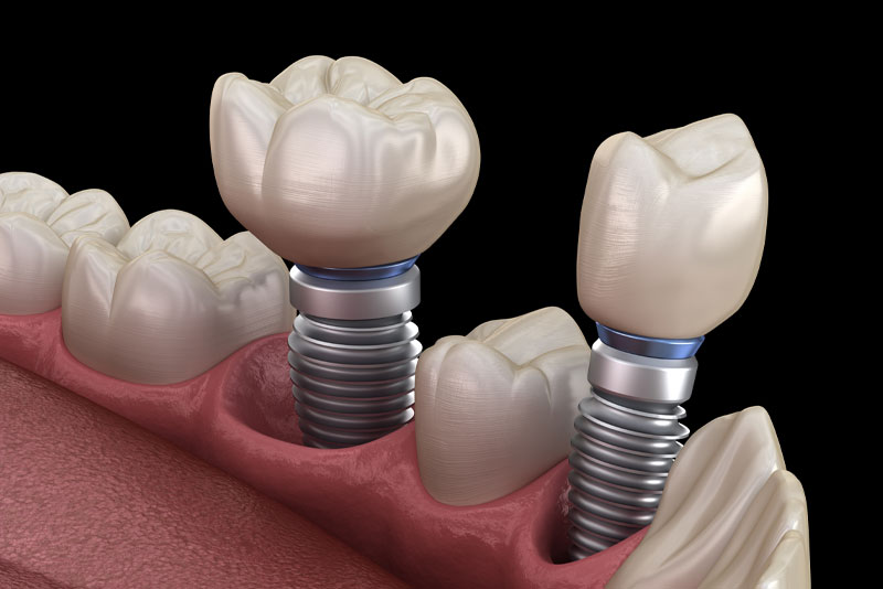 Dental Implants in your Mouth