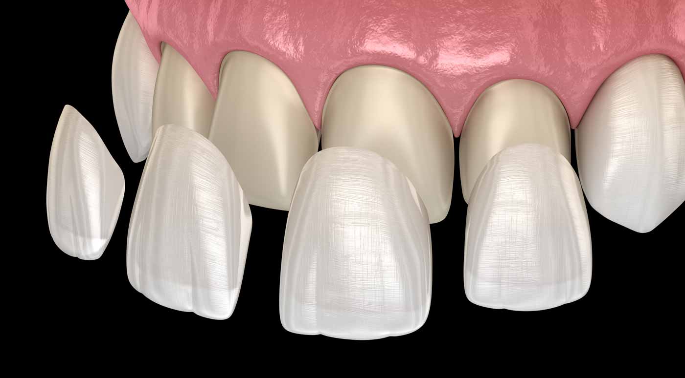 a diagram showing how porcelain veneers are placed