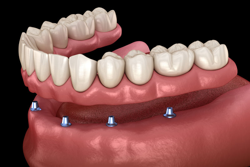 a digital model of a lower arch implant supported denture tooth replacement.